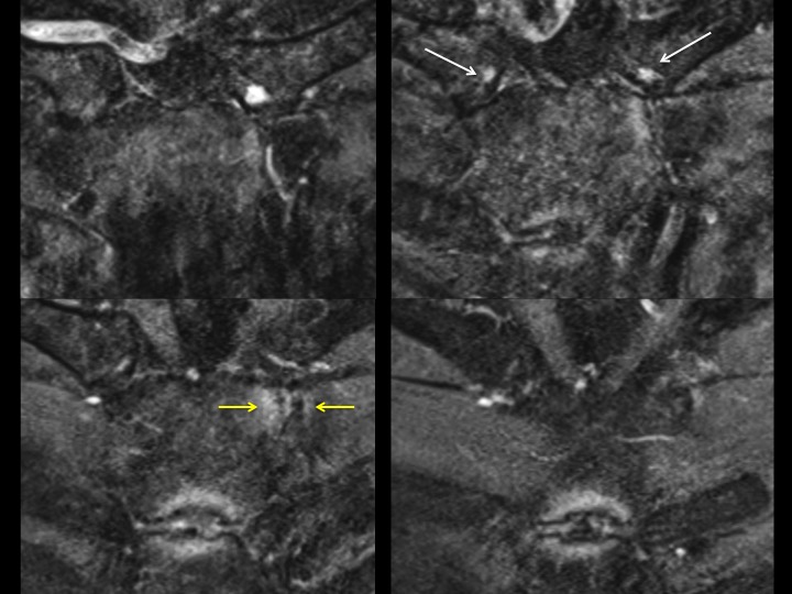 Figure 2 for case manubrium ( RID2476 )
